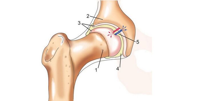 bedrový kĺb a artróza