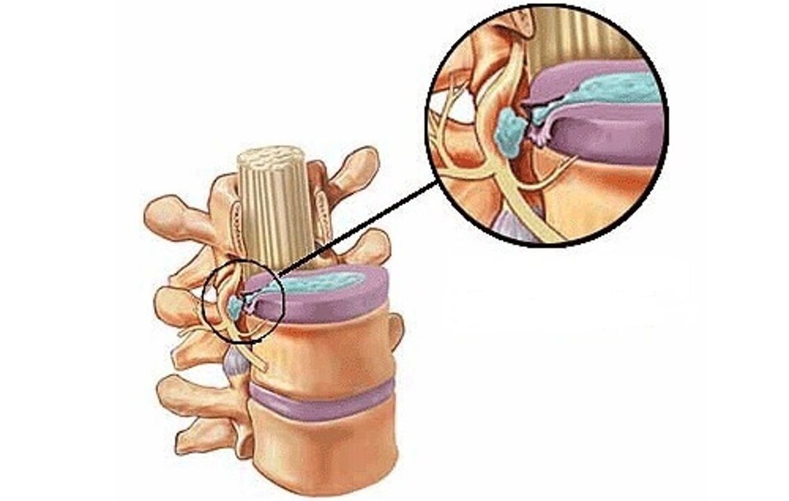 intervertebrálna hernia s hrudnou osteochondrózou